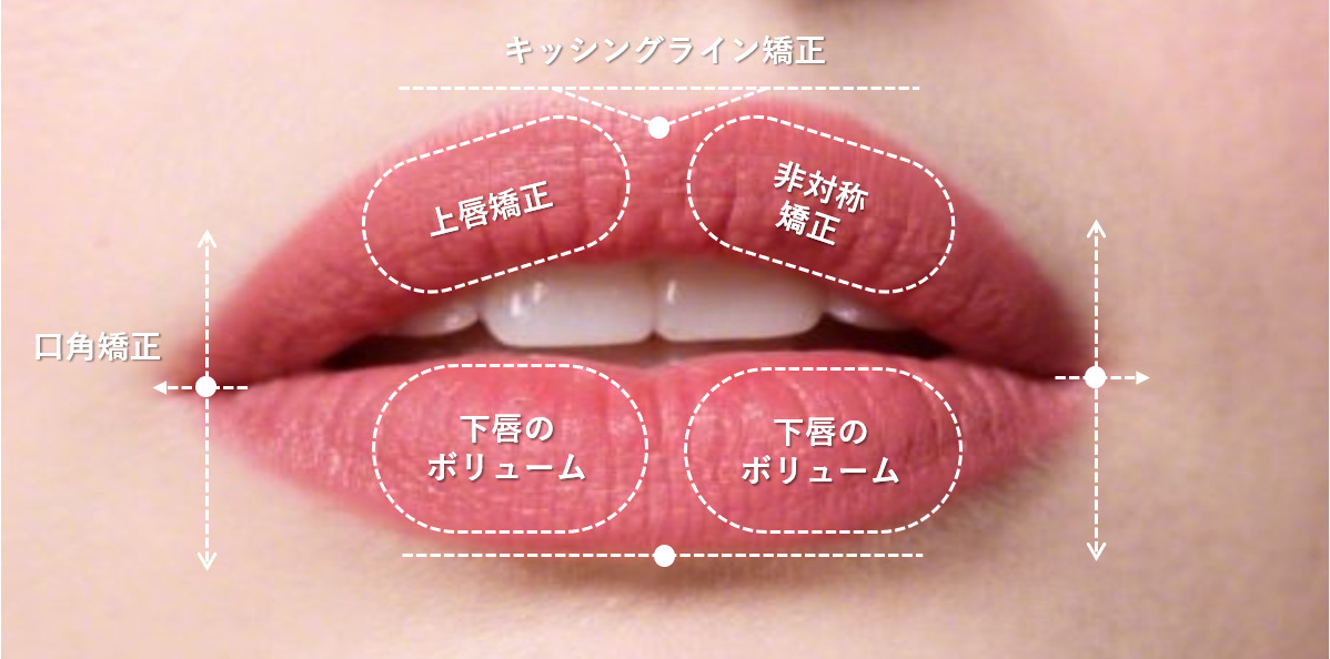 MuseFill Lip 施術部位